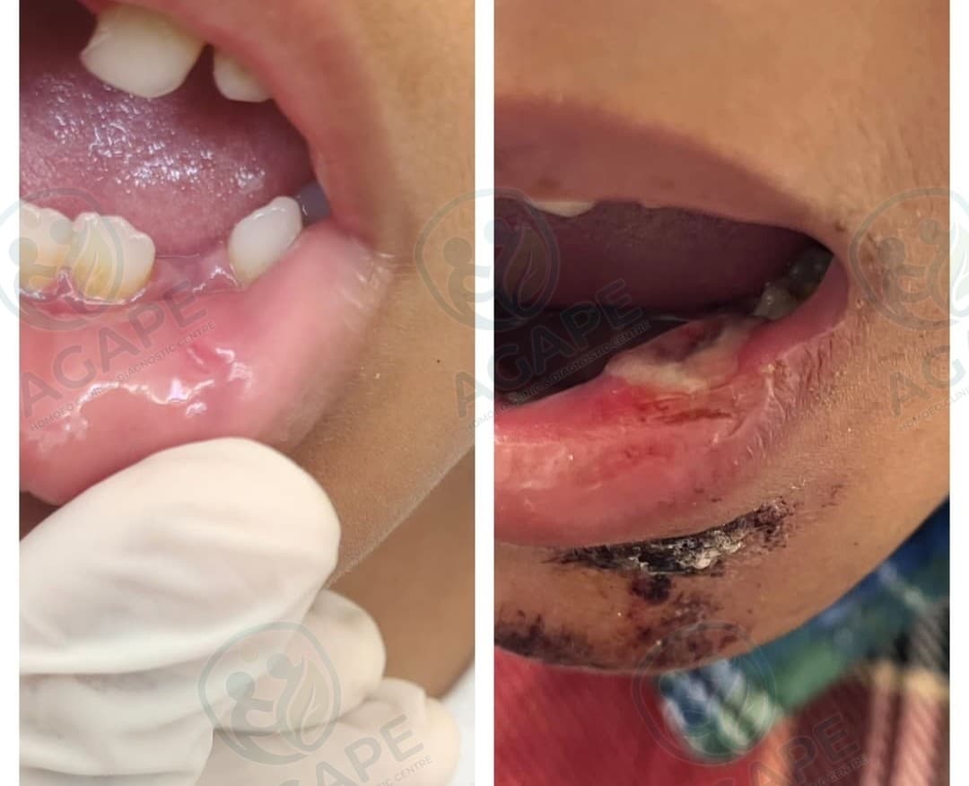 Successful homoeopathic treatment
